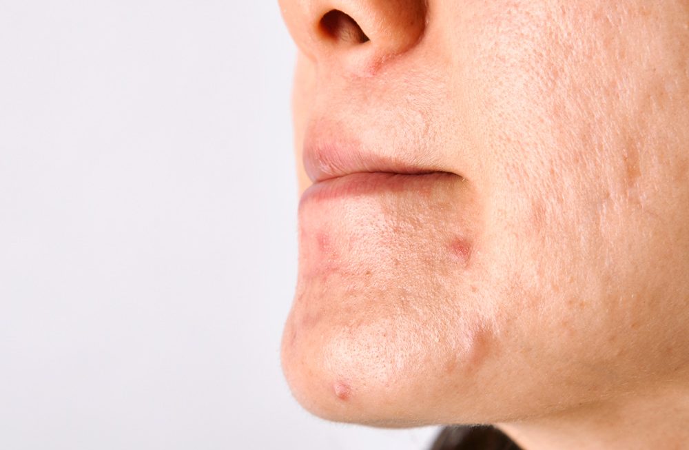 Acne e Nutrição