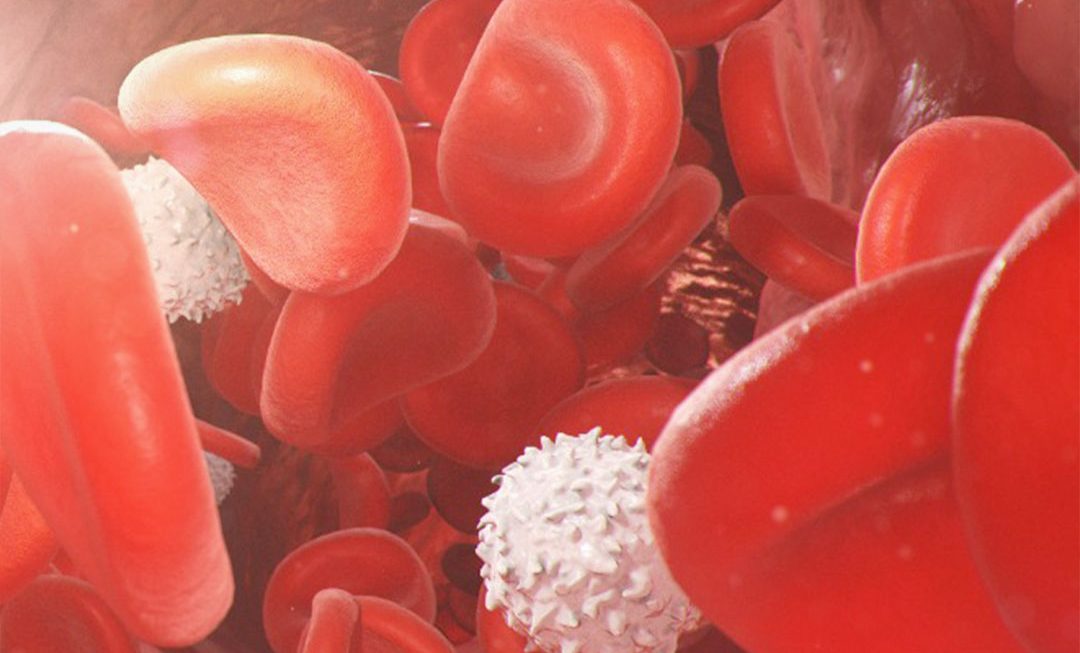 Anemia por deficiência de ferro na doença celíaca