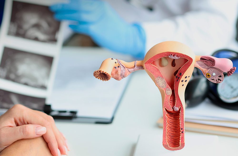 Conhecendo um pouco mais sobre a endometriose