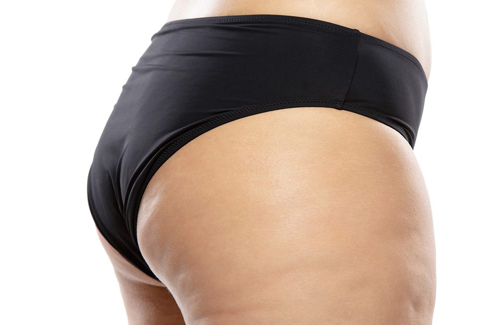A Nutrição no tratamento da celulite