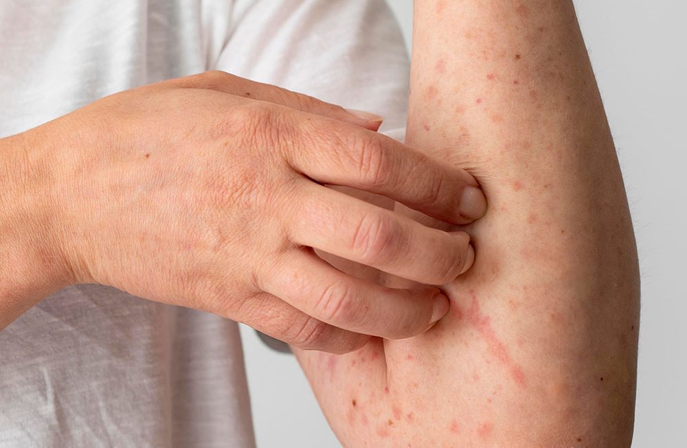 Alimentação e os tipos de dermatite