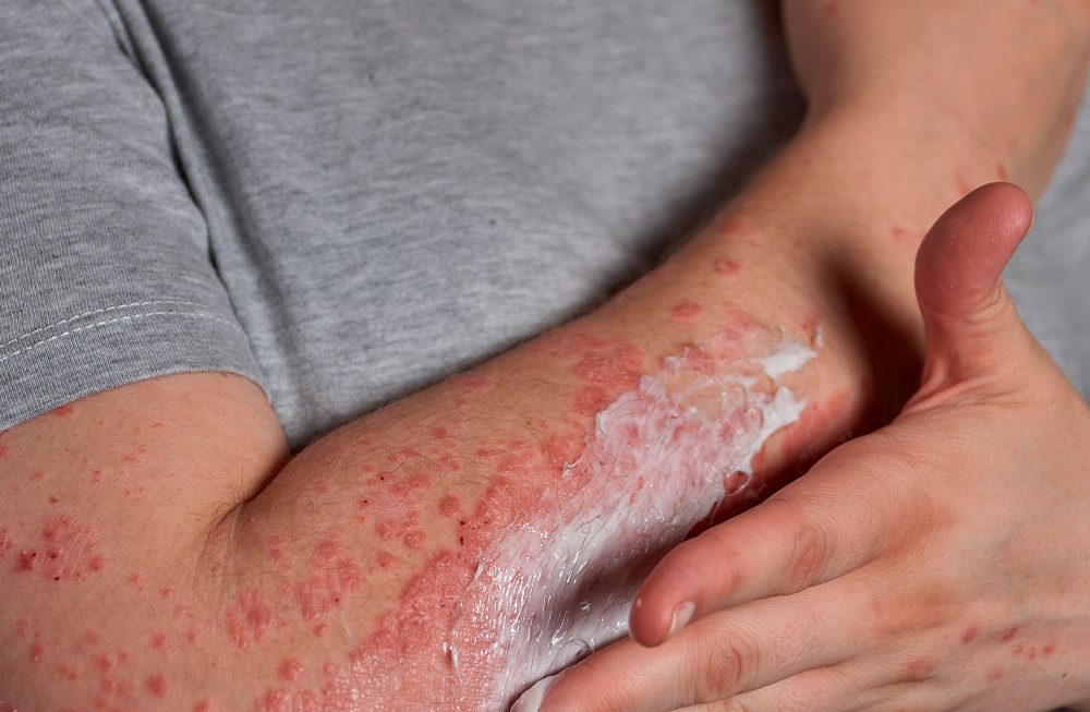 Estratégias nutricionais no tratamento da psoríase