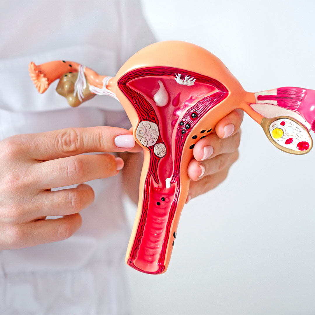 Na imagem, uma médica usa de equipamento ilustrativo para explicar o que é um mioma uterino